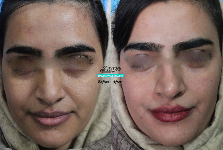 لیزر کربن پیل (کیوسویچ) جهت روشن تر کردن تیرگی پوست