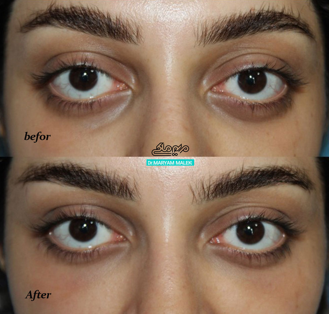 تزریق فیلر در زیر چشم جهت پر کردن گودی زیر چشم