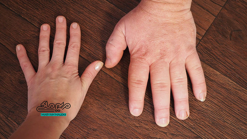 Acromegaly