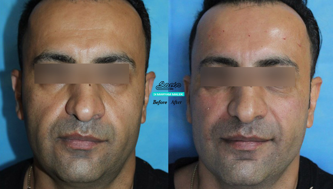 بلافاصله پس از تزریق ژل الانسه در قسمت میانی صورت و زیر چشم همراه با لیزر جنسیس و تزریق بوتاکس