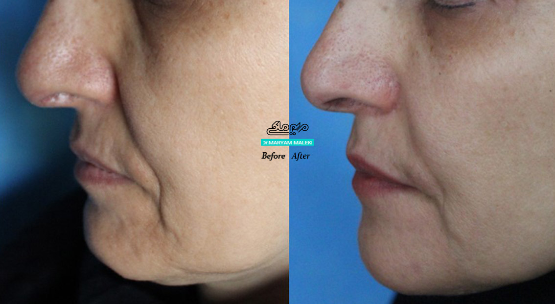 ژل الانسه ، از ژلهای محرک کلاژن است که پس از تزریق علاوه بر حجم دهی ،سبب سفت و کشیده تر شدن و کاهش شلی پوست میشود.