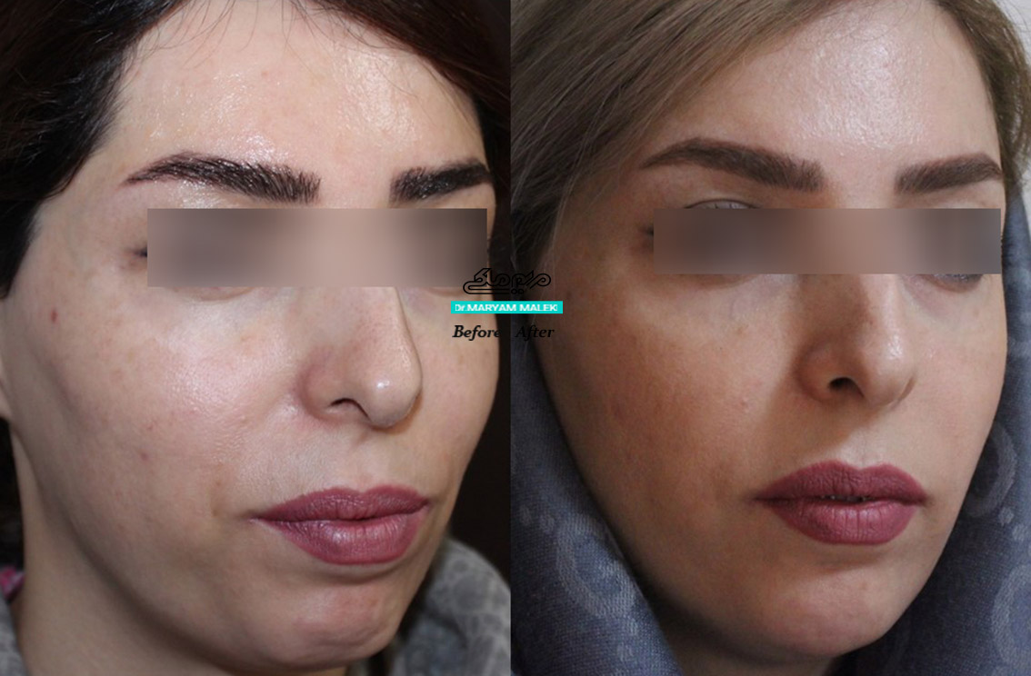 تزریق فیلر در حد برطرف کردن نواقص مختصر صورت و نتیجه کاملا طبیعی