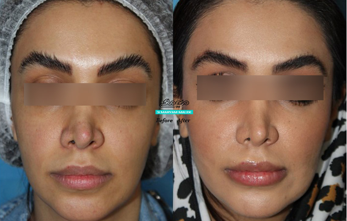 تزریق فیلر در قسمت میانی صورت به روش بسیار طبیعی