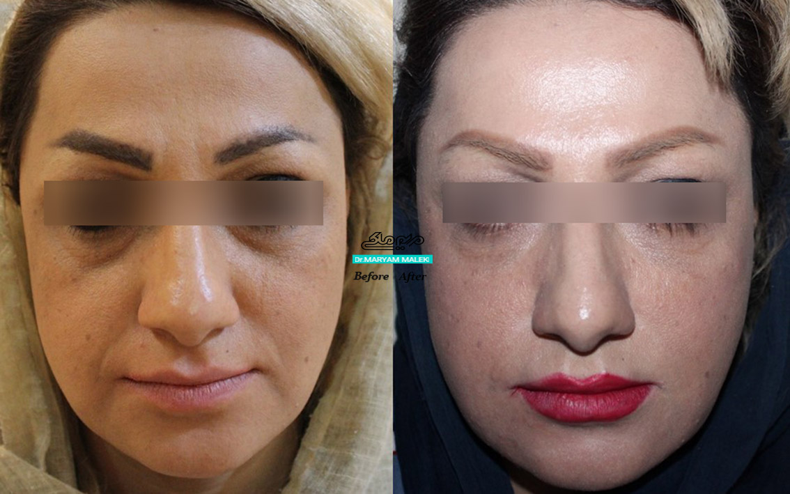 تزریق فیلر در خط خنده و زیر چشم