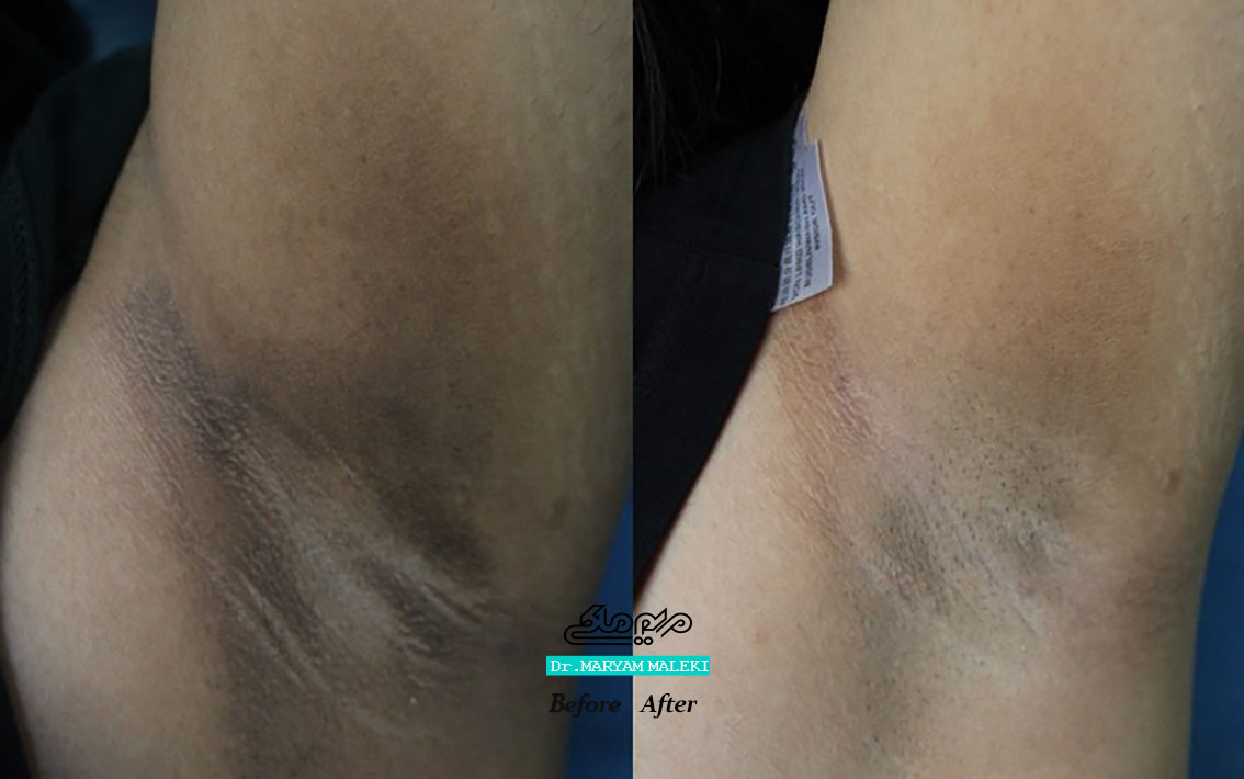 درمان تیرگی-زیر-بغل با لیزر