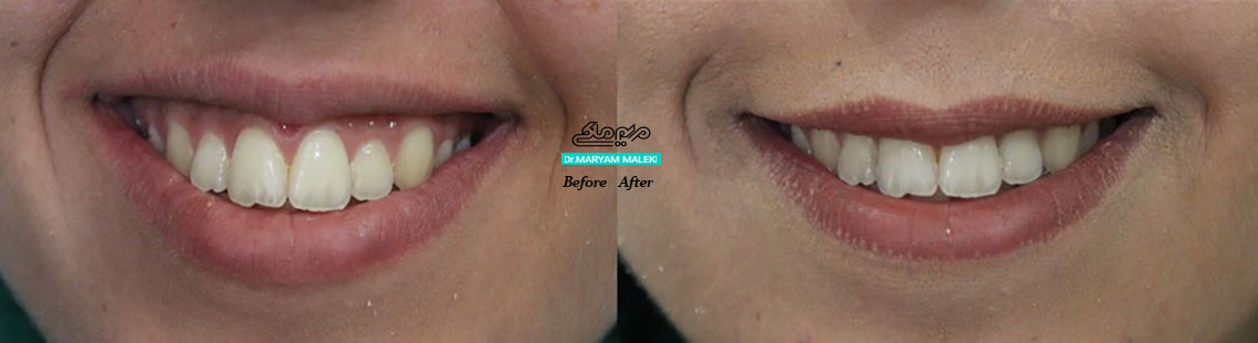 اصلاح فرم لبخند با بوتاکس