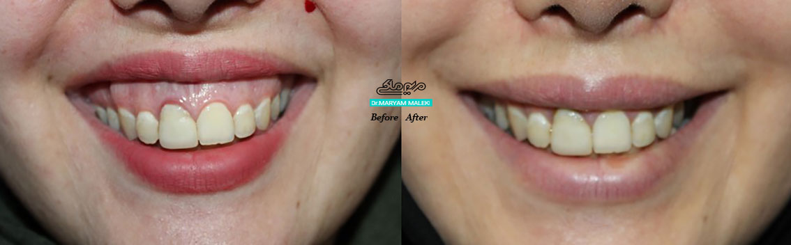 بهبود ظاهر لبخند با بوتاکس