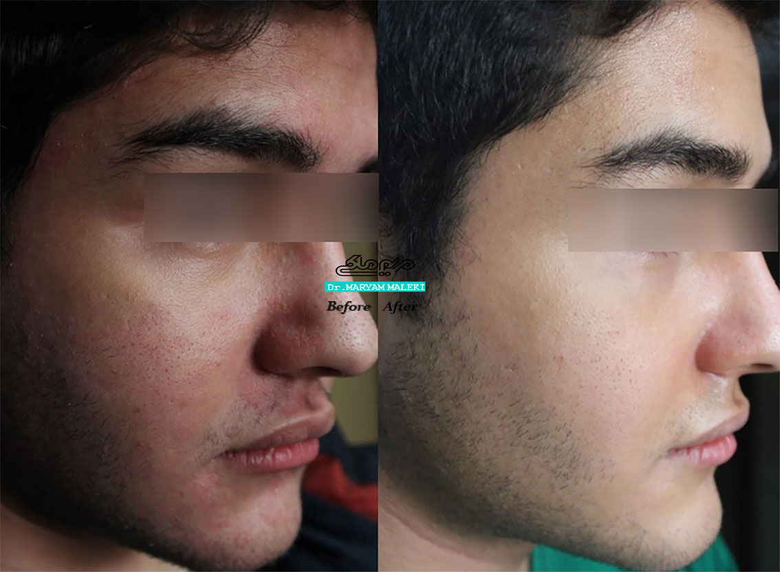 درمان سبوره بعد از یک جلسه آی پی ال