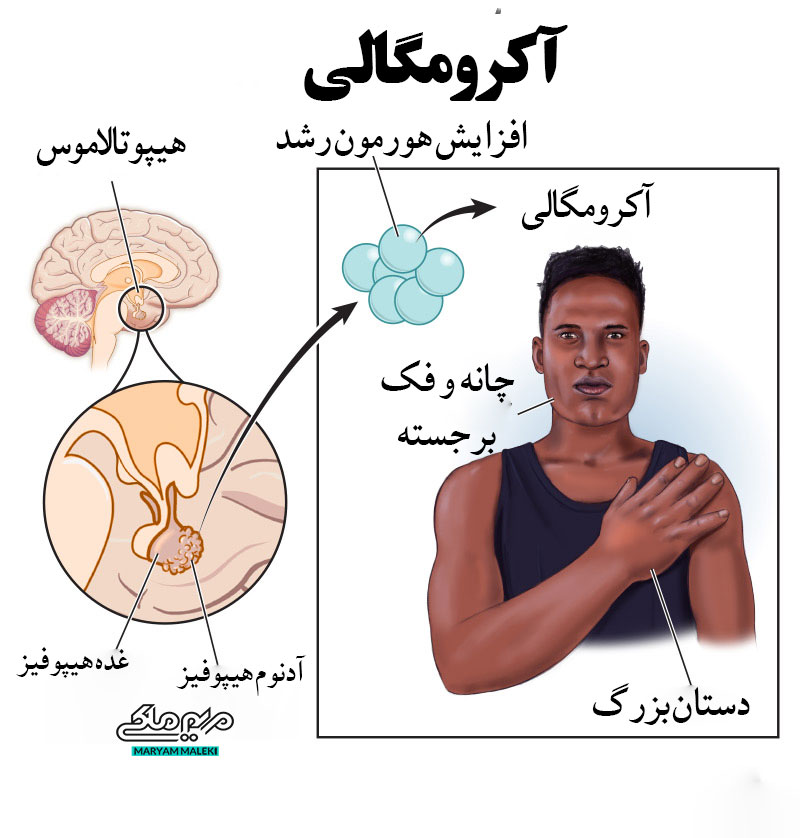 علت-آکرومگالی