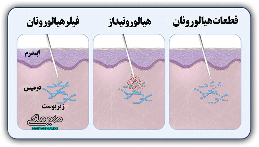 هیالورونیداز چیست؟