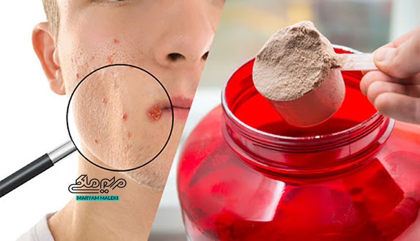 پروتئین-وی و آکنه