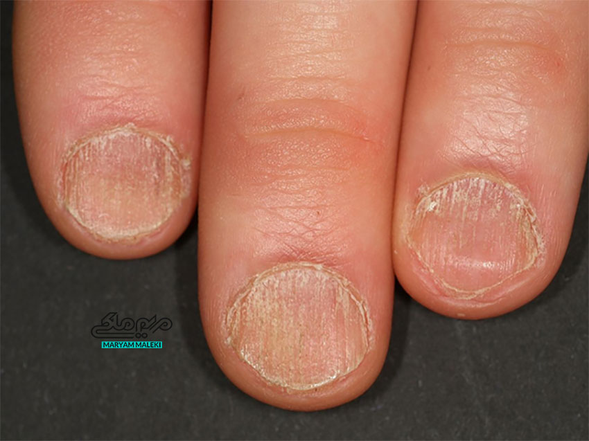 سندروم-دیستروفی-بیست-ناخن-تراکیونیشیا