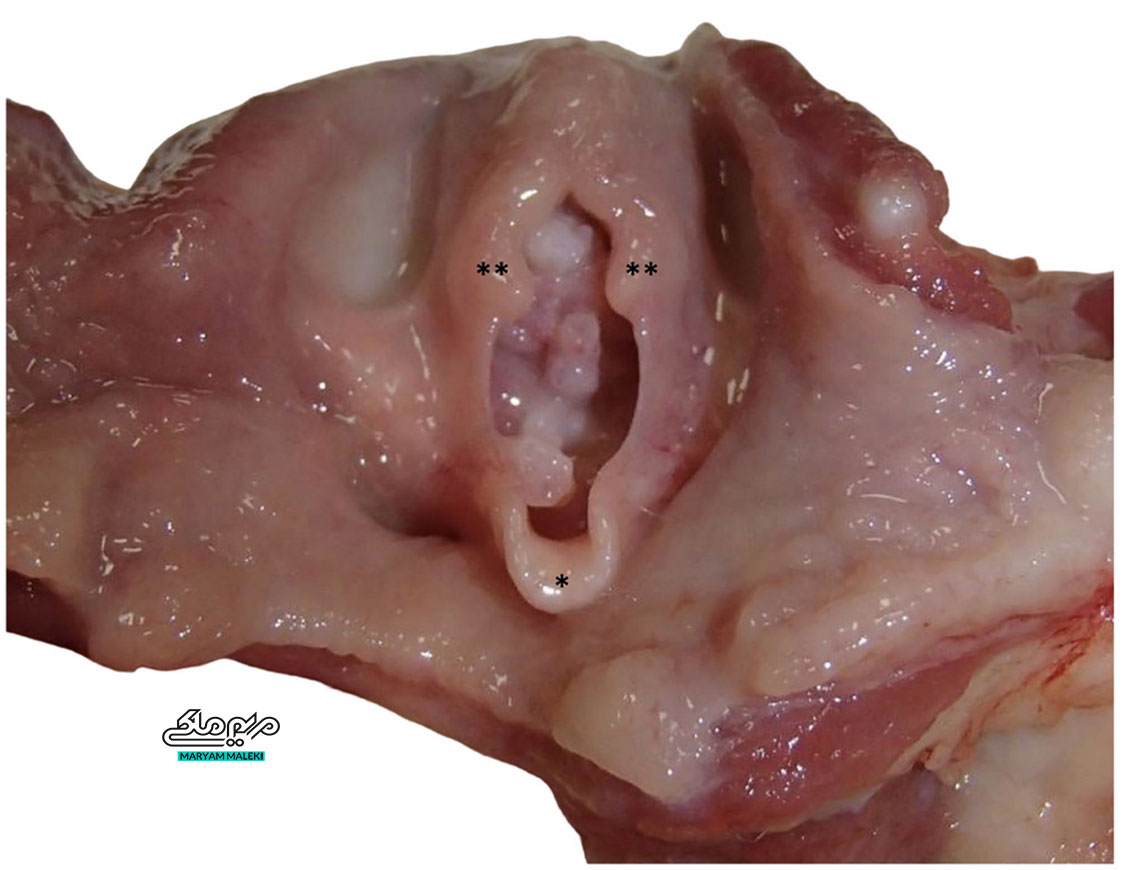 وستیبولار پاپیلوماتوز