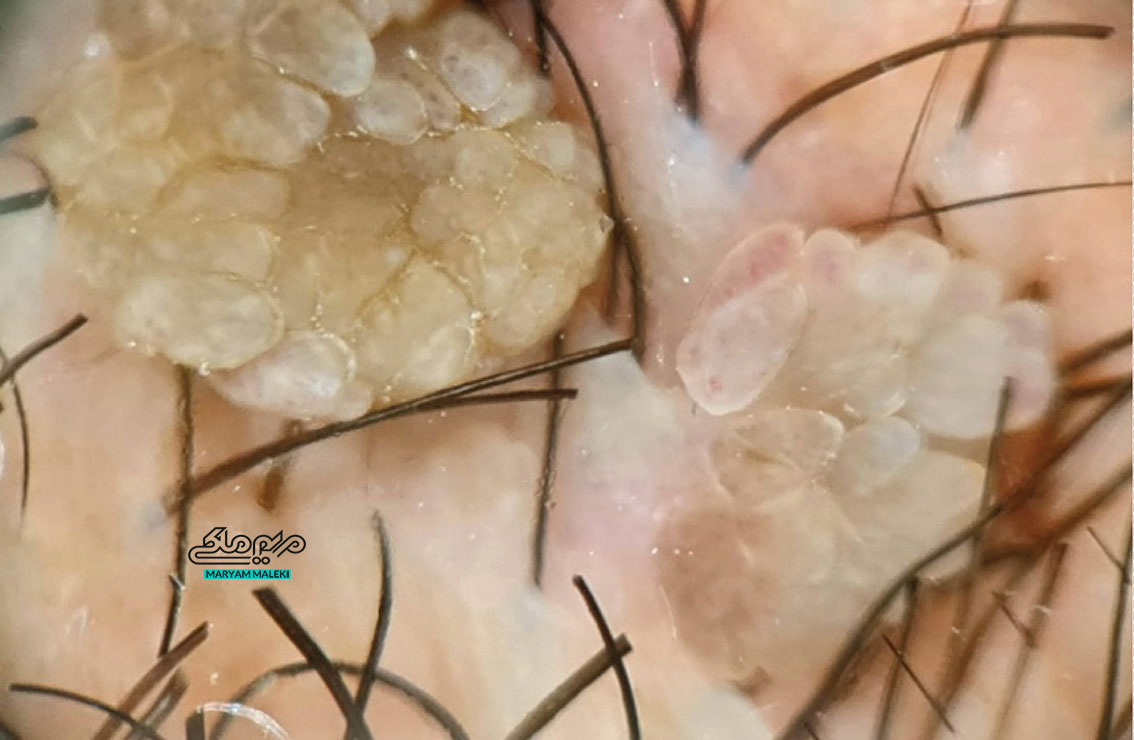 زگیل تناسلی