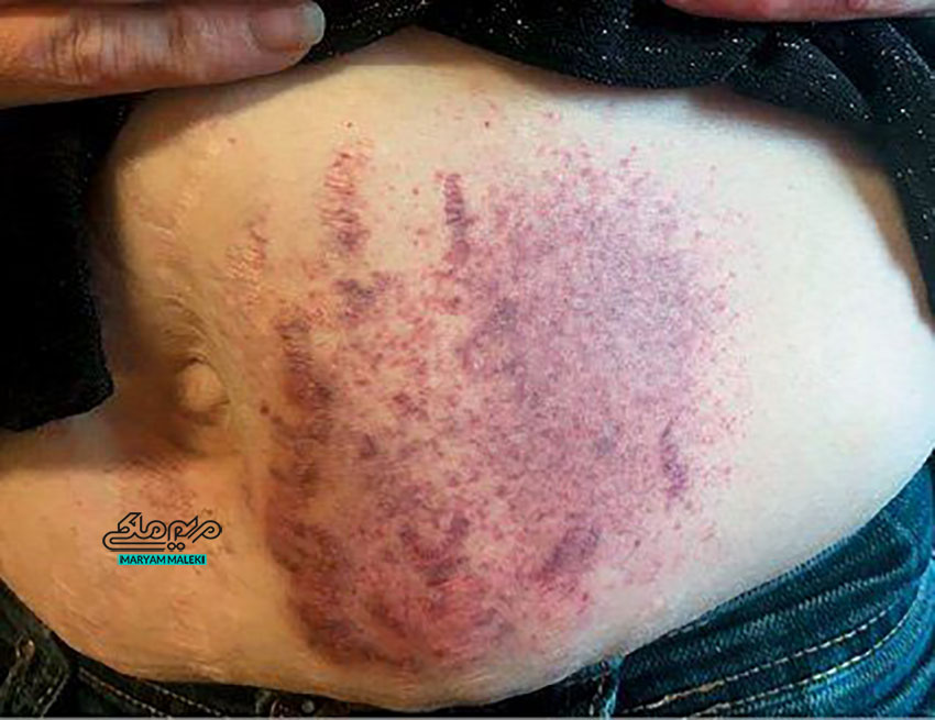 سندرم گاردنر-دیاموند